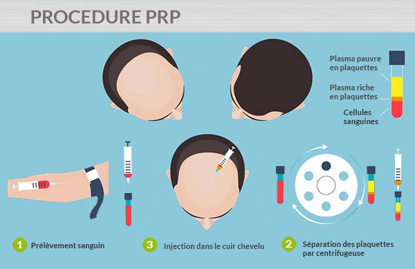 Traitement de la calvitie par PRP